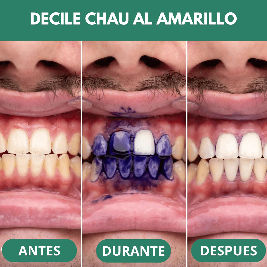 WhiteSmile™ - Blanqueador Dental v34 (OFERTA 2x1 ¡SOLO HOY!)